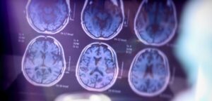 National Alzheimer’s Disease Awareness Month